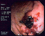 Gastric MALT lymphoma 2.jpg