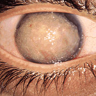 Gelatinous drop-like corneal dystrophy 1.JPEG