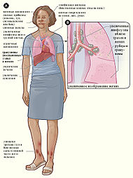 Sarcoidosis signs and symptoms(rus).jpg