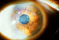 Subepithelial mucinous corneal dystrophy 1.JPEG